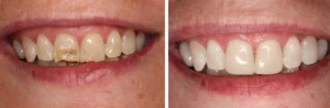 Composite Bonding - Before & After - Drogheda Dentist